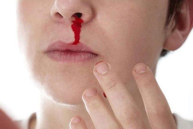 Mơ thấy bị chảy máu cam thường là giấc mơ xấu