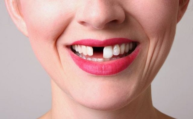 Mơ thấy gãy răng đánh con gì? Giải mã giấc mơ thấy gãy răng 